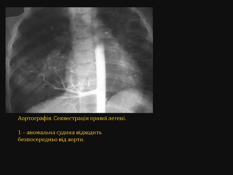 Аортографія. Секвестрація правої легені.  1 – аномальна судина відходить безпосередньо від аорти.